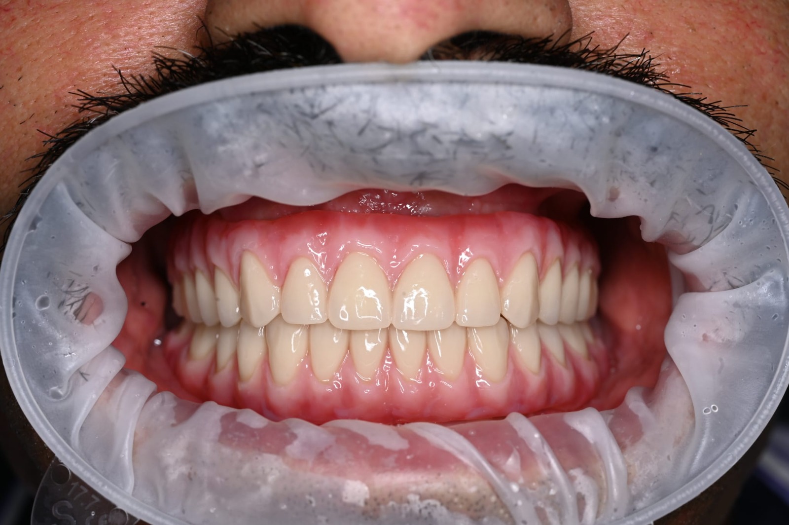 Lucrare dentară fixă finalizată pe implanturi – Estet Dent Brăila