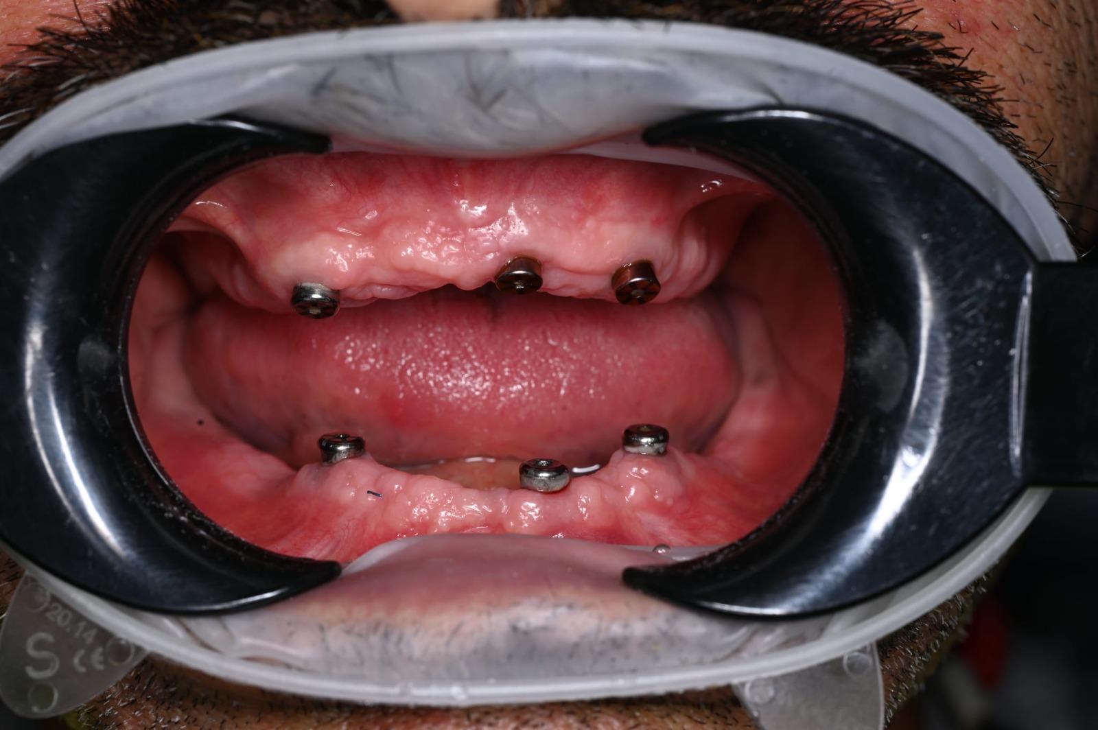 Implanturi dentare inserate în os, înainte de montarea lucrării – Estet Dent Brăila