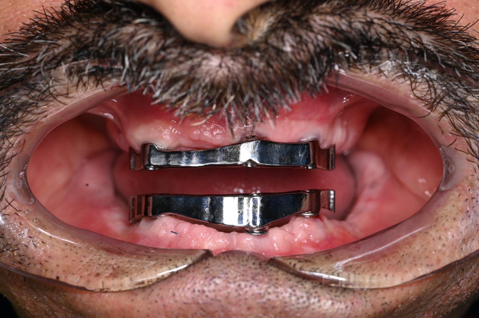 Structură fixă montată pe implanturi dentare – Estet Dent Brăila
